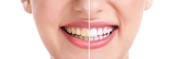 Teeth Whitening - Dental Discount Plan