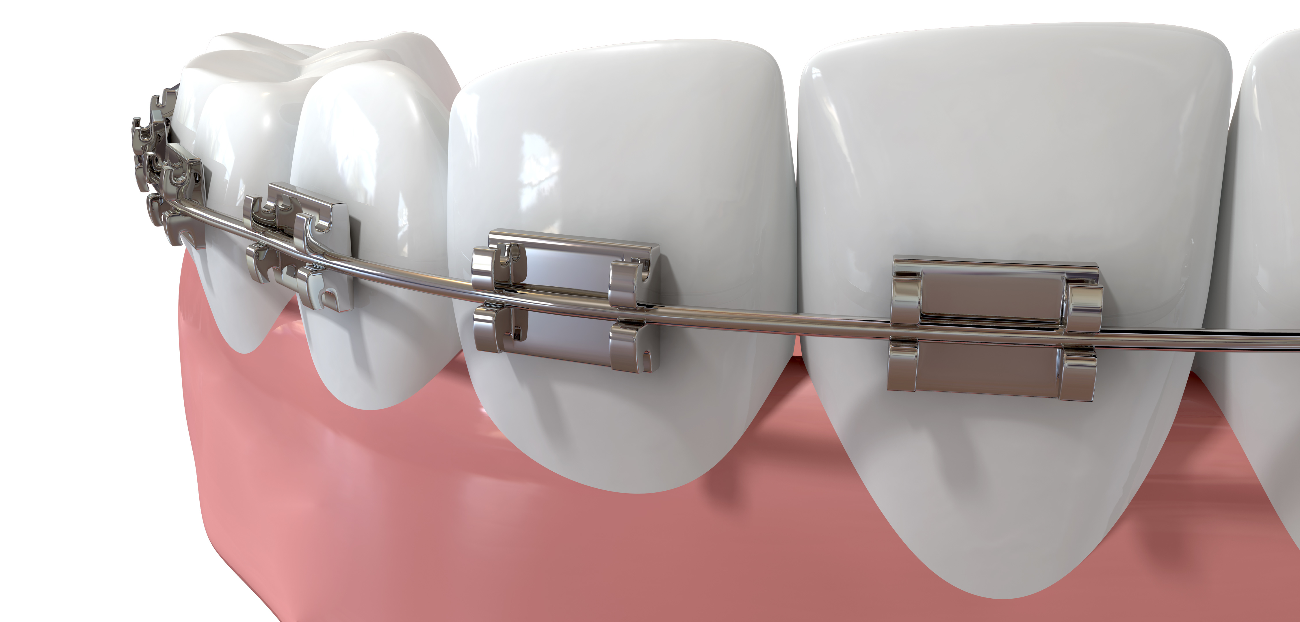 The value of braces and orthodontics