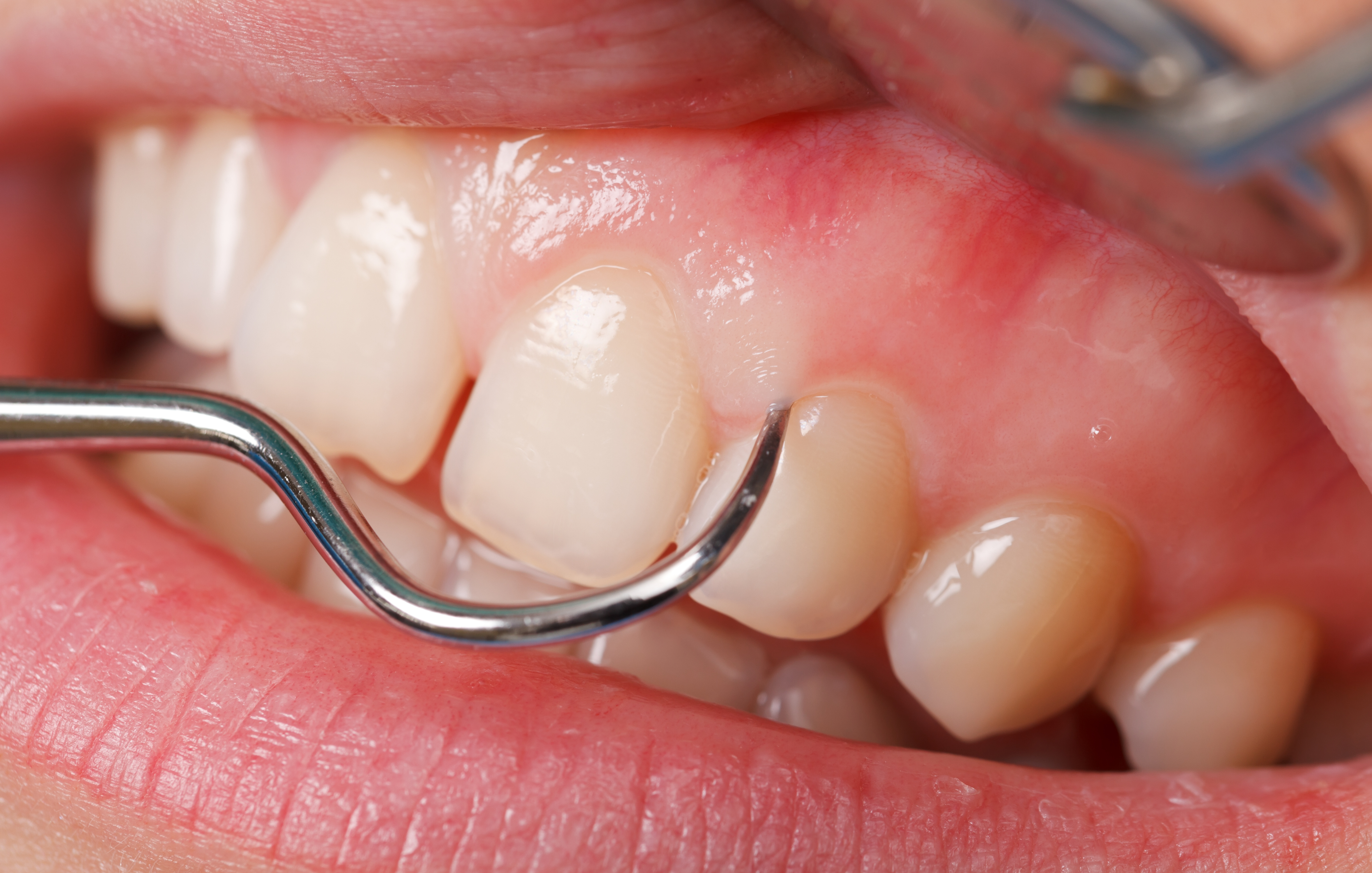 Who is at risk for gum disease?